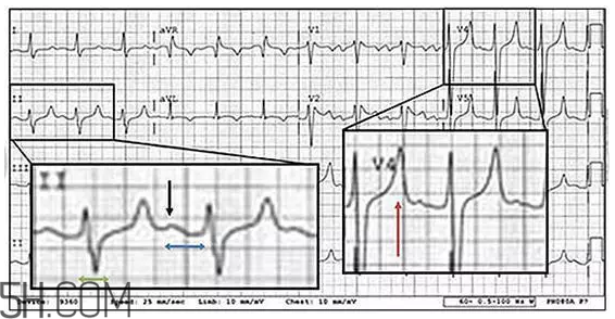 心電圖怎么看？6種常見心電圖異常情況