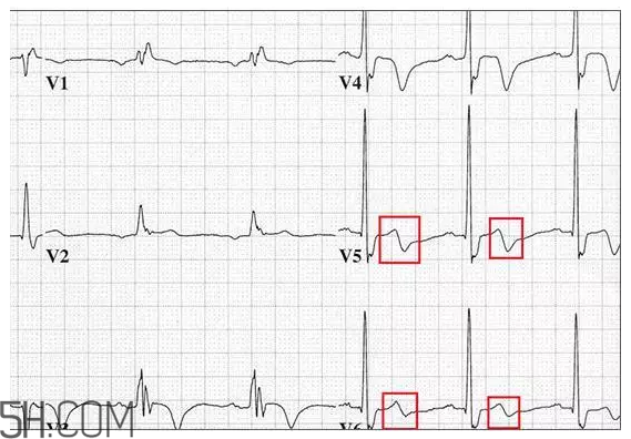 心電圖怎么看？6種常見心電圖異常情況