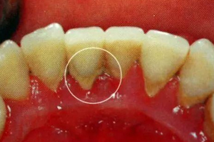 牙結(jié)石能自動脫落嗎？除了洗牙別無他法