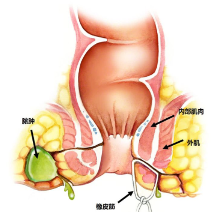 肛瘺非手術(shù)治療才可以嗎？手術(shù)是治療的關(guān)鍵途徑