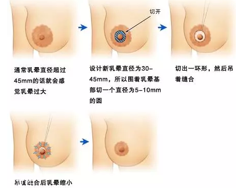 乳暈縮小術(shù)怎么做？乳暈縮小術(shù)知識全解