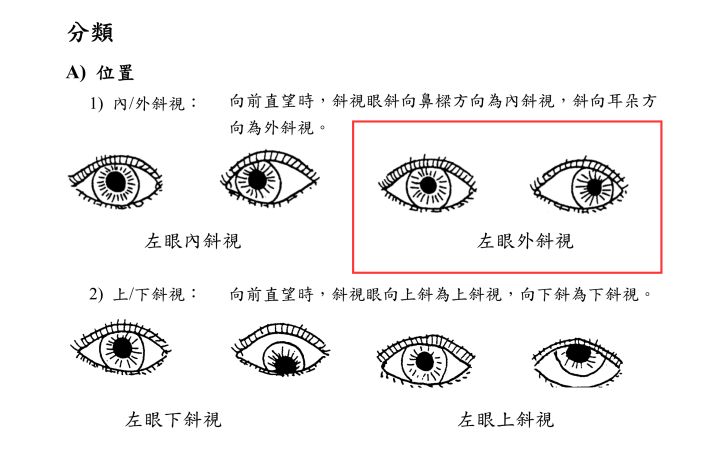 斜視是什么意思 斜視帶來生活的影響