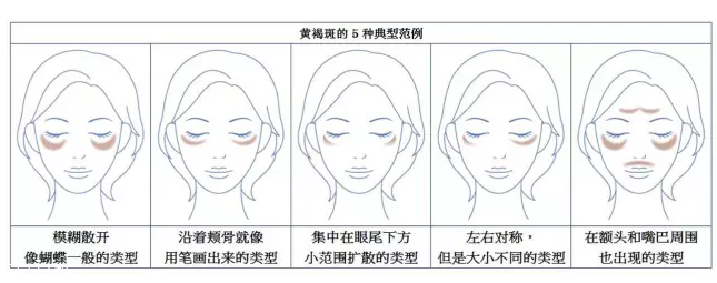 祛斑美白什么產品最有效 日常祛斑小妙招