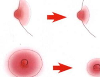 乳暈縮小術(shù)全千萬(wàn)別做 乳暈縮小術(shù)不宜人群