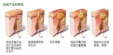 頑固痘痘怎么消除？油皮為什么反復(fù)爆痘？