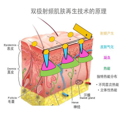 射頻美容儀原理是什么 皮薄敏感肌不適合用