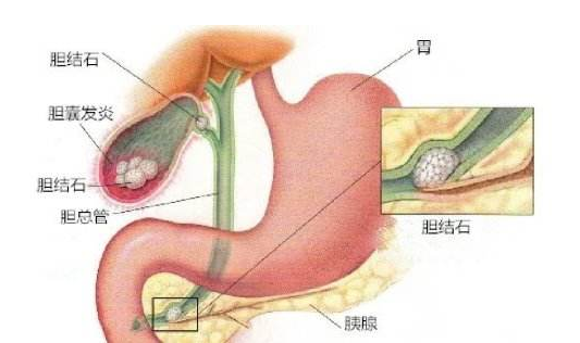 膽結(jié)石的食療方法 如何預(yù)防膽結(jié)石