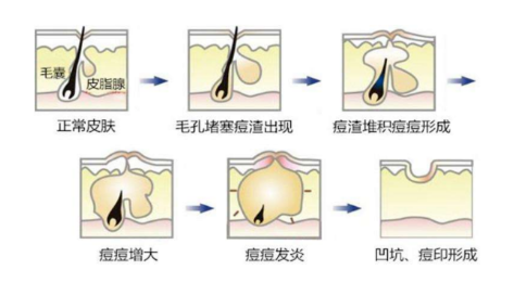 紅腫痘痘怎么快速消腫 遠(yuǎn)離紅腫痘痘大作戰(zhàn)