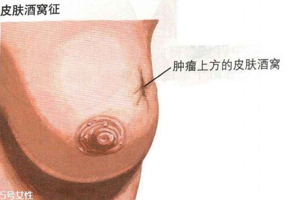 乳腺癌的早期癥狀 帶你認(rèn)識(shí)乳腺癌