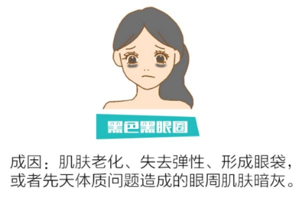 如何分辨黑眼圈類型 找對(duì)類型對(duì)癥下藥