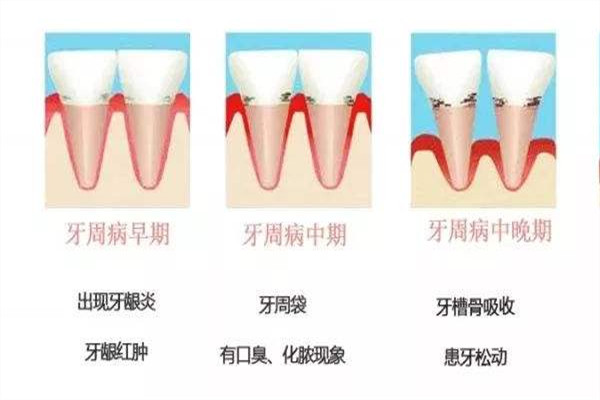 口腔健康的標(biāo)準(zhǔn)是什么 口腔健康管理