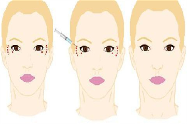 注射除皺針會老的更快嗎 除皺針好壞處