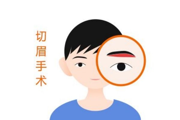 切眉有什么作用 為什么要切眉