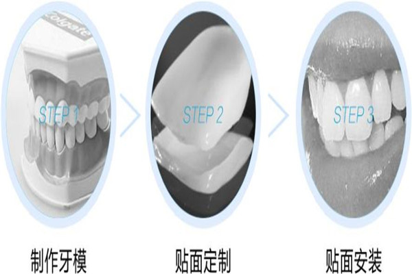 牙齒貼片的副作用是什么 牙齒貼片的危害是什么