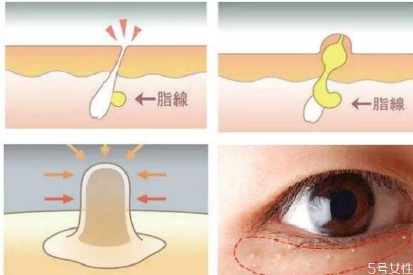 脂肪粒是怎么形成的呢 脂肪?？梢宰约汉脝?></p><h3>脂肪?？梢宰约汉脝?/h3><p>很多人都有長脂肪粒的煩惱，但是卻并不是所有長脂肪粒的人都知道要怎么去去除它們，還有很多女生覺得，脂肪粒長了就長了，沒必要去搭理它們，過段時(shí)間之后皮膚就會(huì)自動(dòng)的把它們的消滅了。雖說，我們每一個(gè)人的皮膚確實(shí)有自我修復(fù)的作用，有一部分脂肪粒也確實(shí)可以在一定的時(shí)間內(nèi)被我們自身的調(diào)節(jié)機(jī)制去除，但是大部分人長的脂肪粒，并不會(huì)在時(shí)光里被治愈，而是在漫長的歲月里，一直停留在你臉上，為你的形象減分。</p><p style=