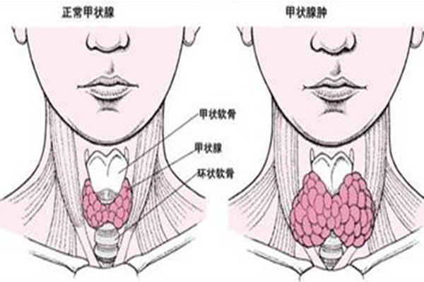 甲狀腺結節(jié)會導致脖子疼嗎 甲狀腺結節(jié)有什么癥狀