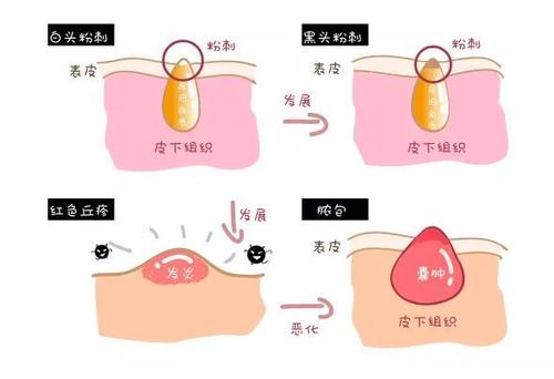 適合長脂肪粒用的眼霜 長脂肪粒適合用什么護(hù)膚品