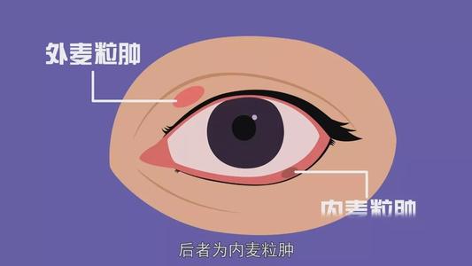 麥粒腫可以戴隱形眼鏡嗎 麥粒腫能傳染嗎