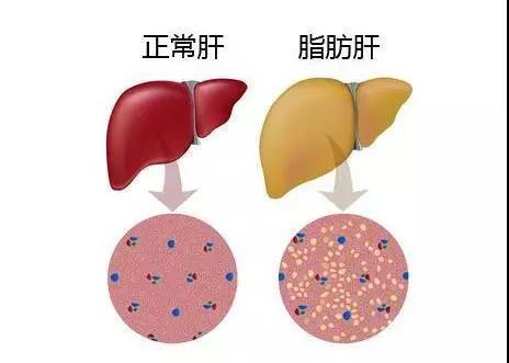 脂肪肝患者一點肉都不能吃嗎 脂肪肝適合高蛋白嗎