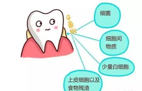 飯后多久用簌口水適合 牙結(jié)石會自己掉嗎