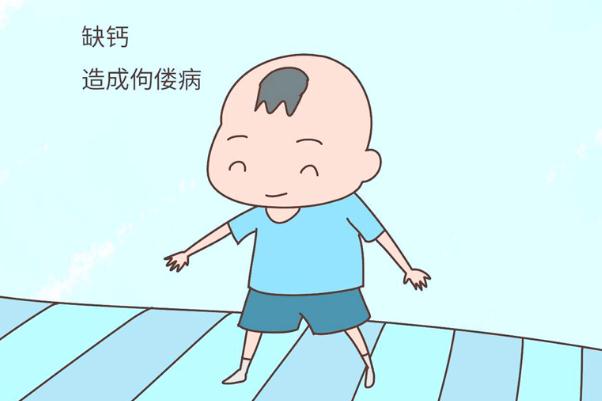 佝僂病有哪些癥狀和表現(xiàn) 佝僂病缺少什么元素