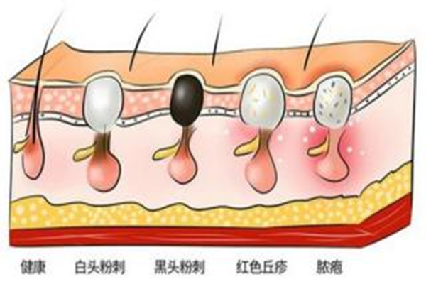 黑頭可以徹底清除嗎 黑頭用什么洗可以輕松洗掉