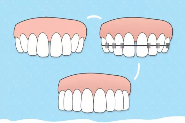 牙齒矯正會(huì)反彈嗎 牙齒矯正會(huì)改變嘴唇嗎