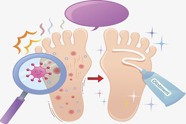 腳氣怎么治療能根除 腳氣是怎么引起的