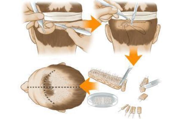 植發(fā)是用自己的頭發(fā)移植嗎 植發(fā)的危害和后遺癥