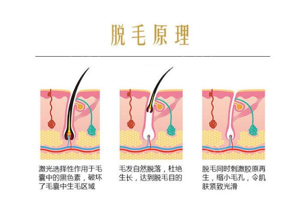 激光脫毛有燒焦的味道 脫毛儀為什么會有燒焦味