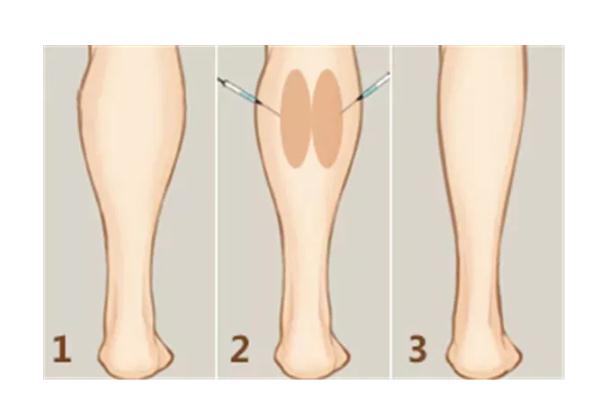 瘦腿針的原理 瘦腿針的危害有什么副作用