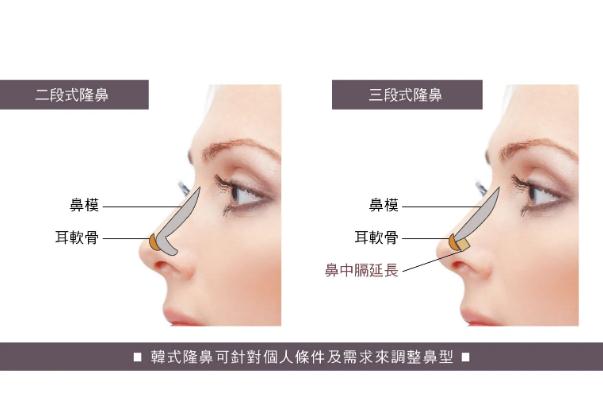 耳軟骨隆鼻可以維持多久 耳軟骨隆鼻需要多少錢