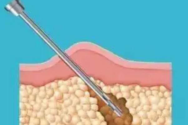 溶脂針的效果和副作用 溶脂針價(jià)格多少錢(qián)一針